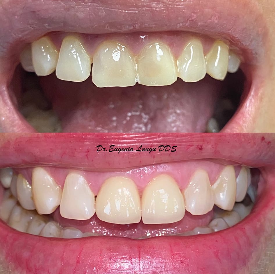 Teeth whitening transformation before and after