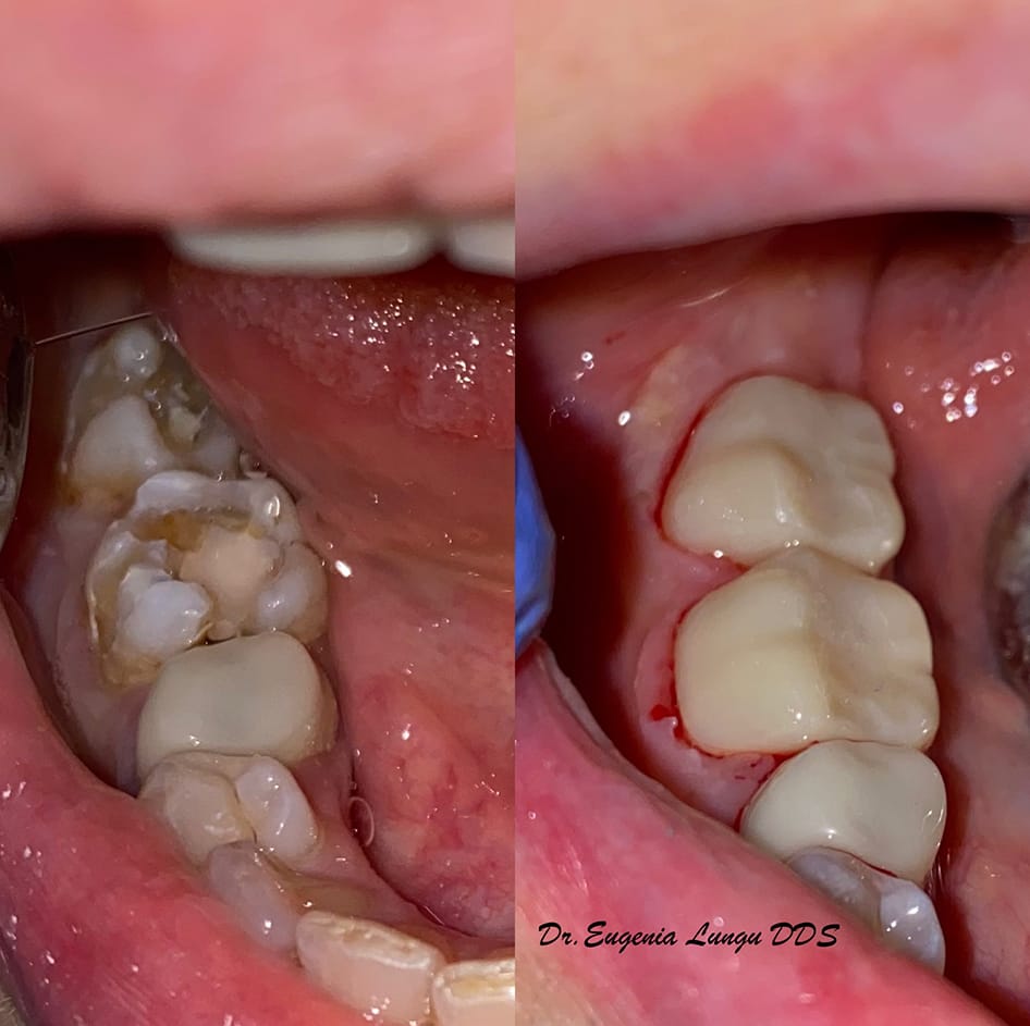 Dental crown treatment before and after