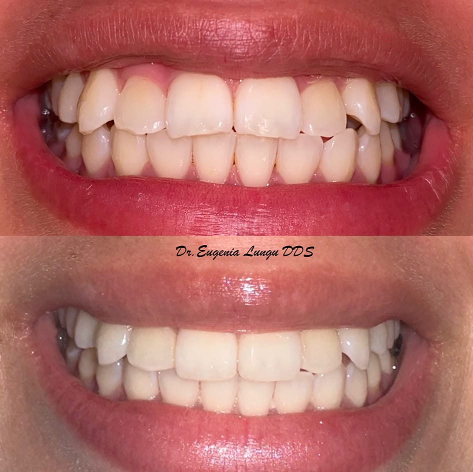Before and after dental teeth whitening