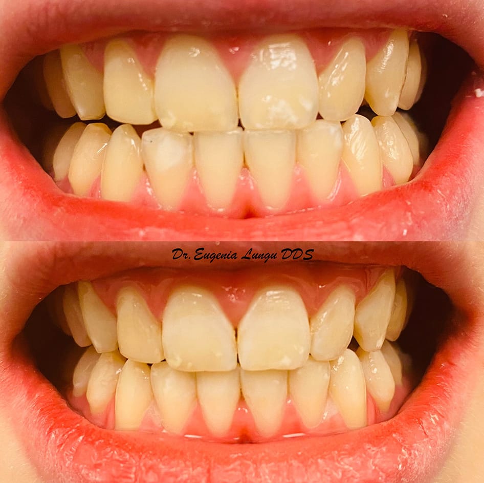 Before and after teeth bleaching results