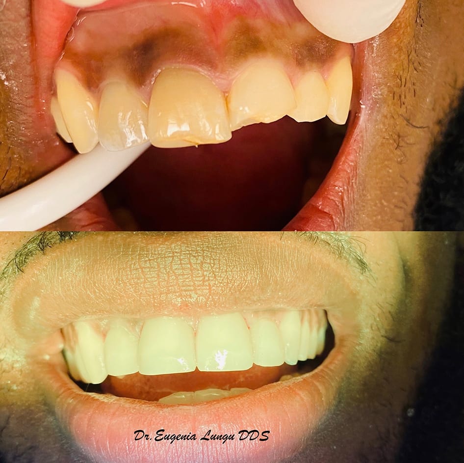 Front tooth treatment before and after