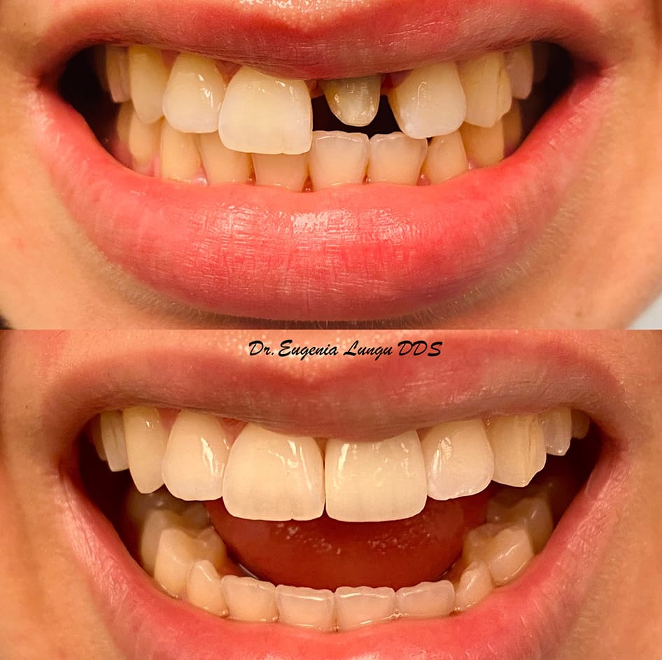 Front tooth veneers before and after