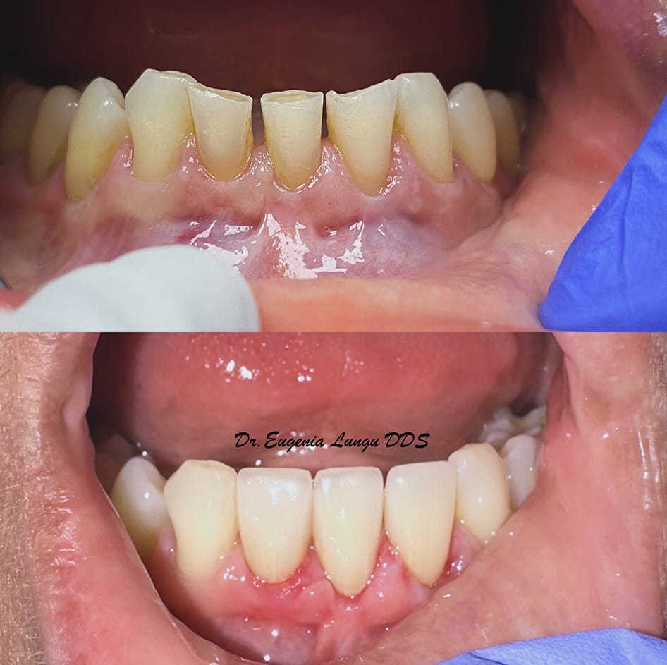 Before and after dental veneers