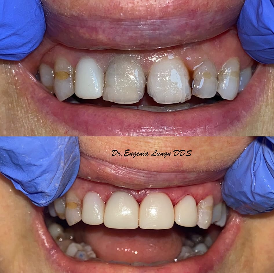 Before and after front tooth veneers