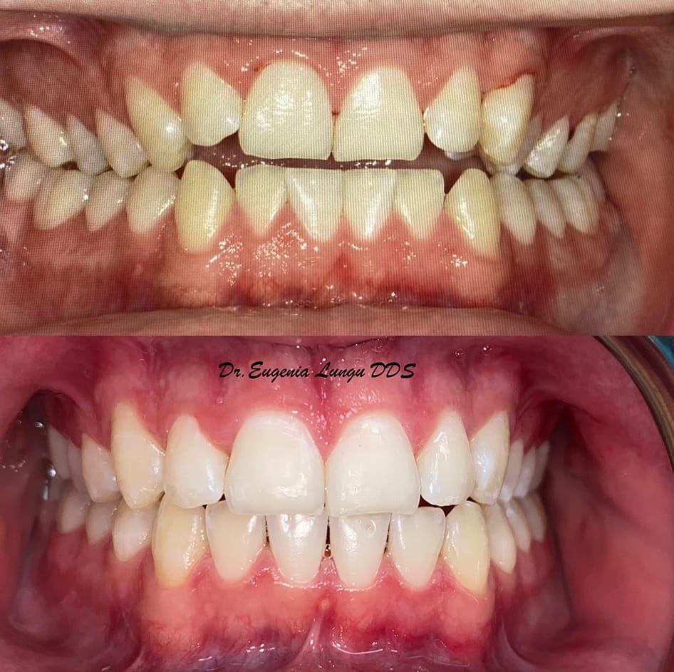 Dental bleaching before and after results