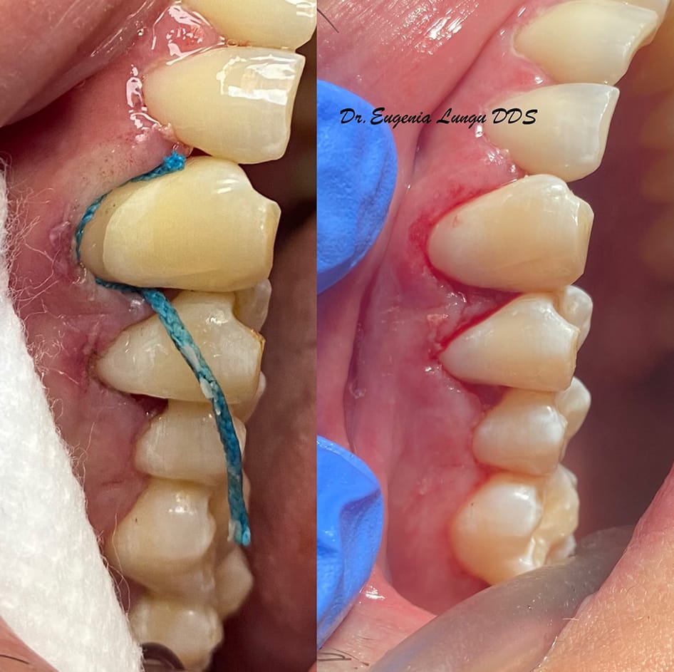 Smile before and after teeth bleaching