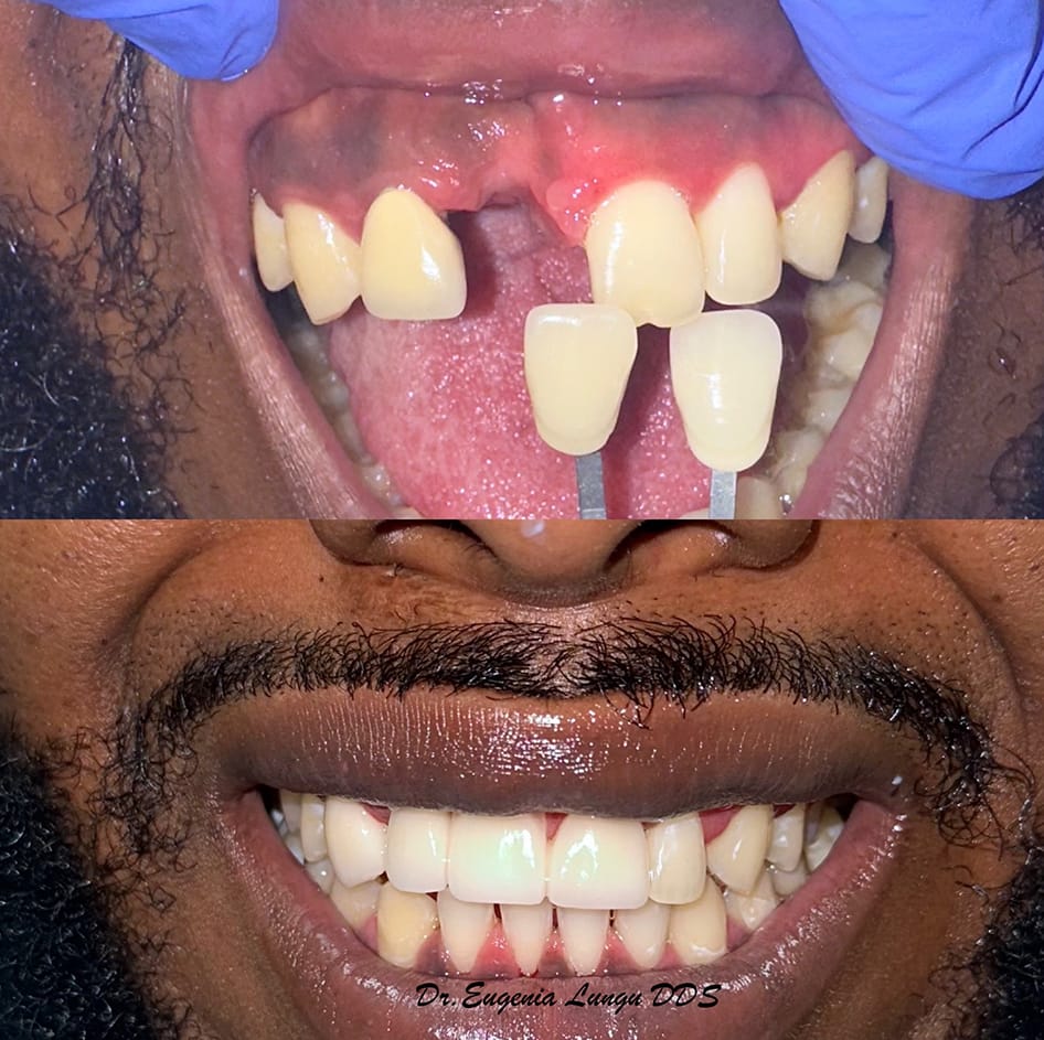 Front tooth dental implants before and after results