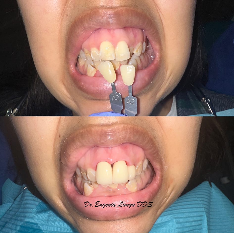 Front tooth veneers before and after results