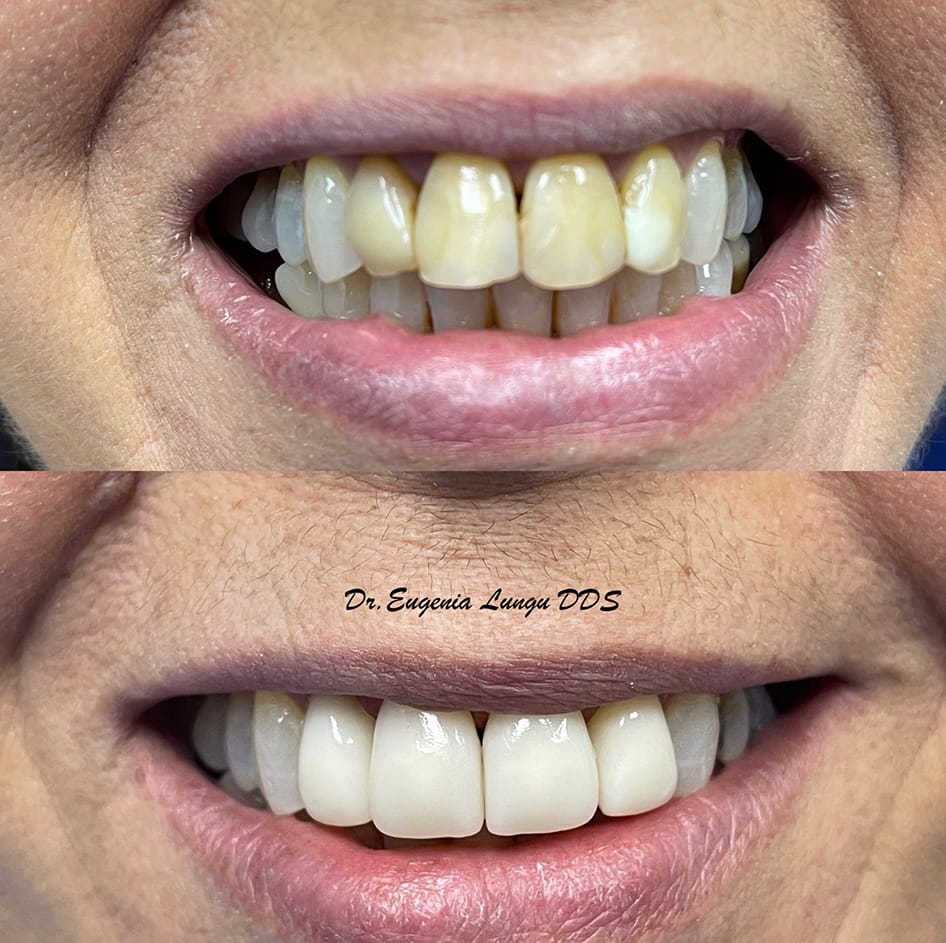 Professional bleaching treatment before and after