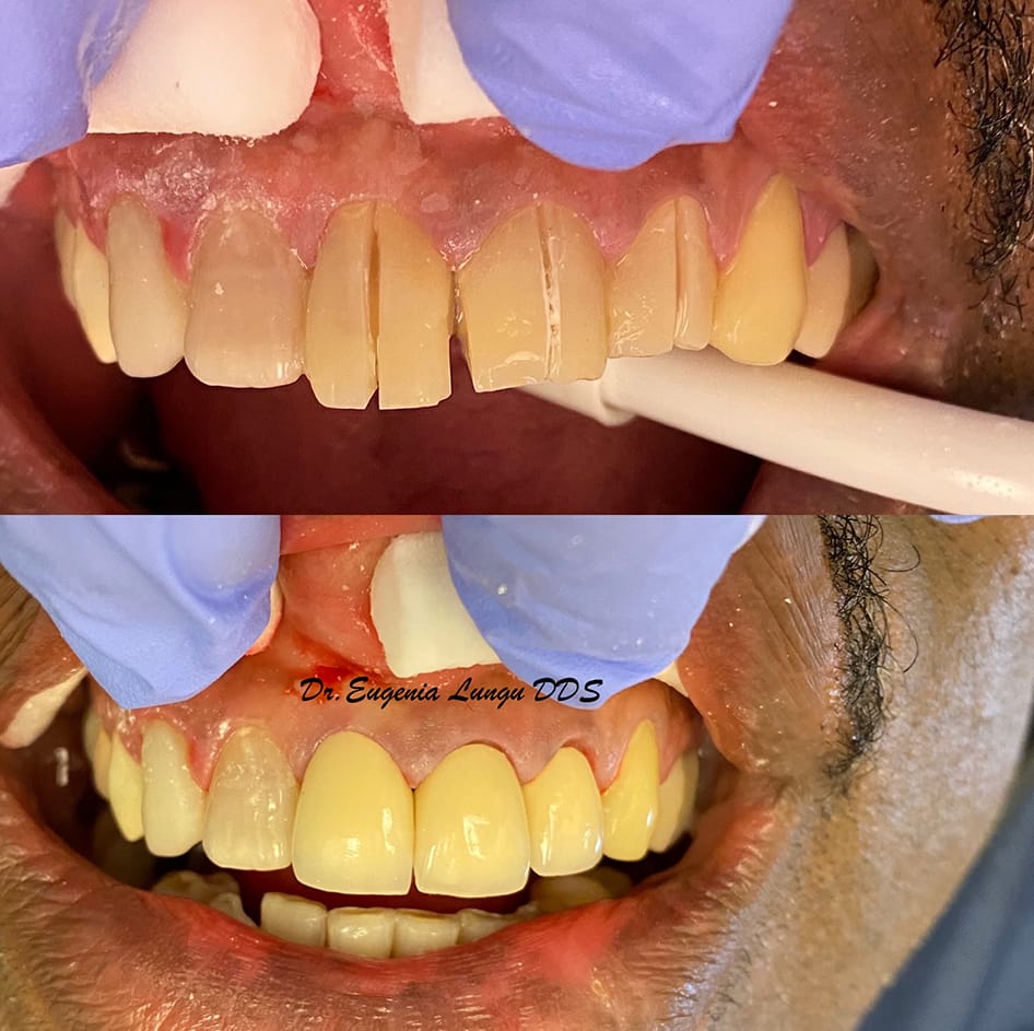 Dental veneers before and after results
