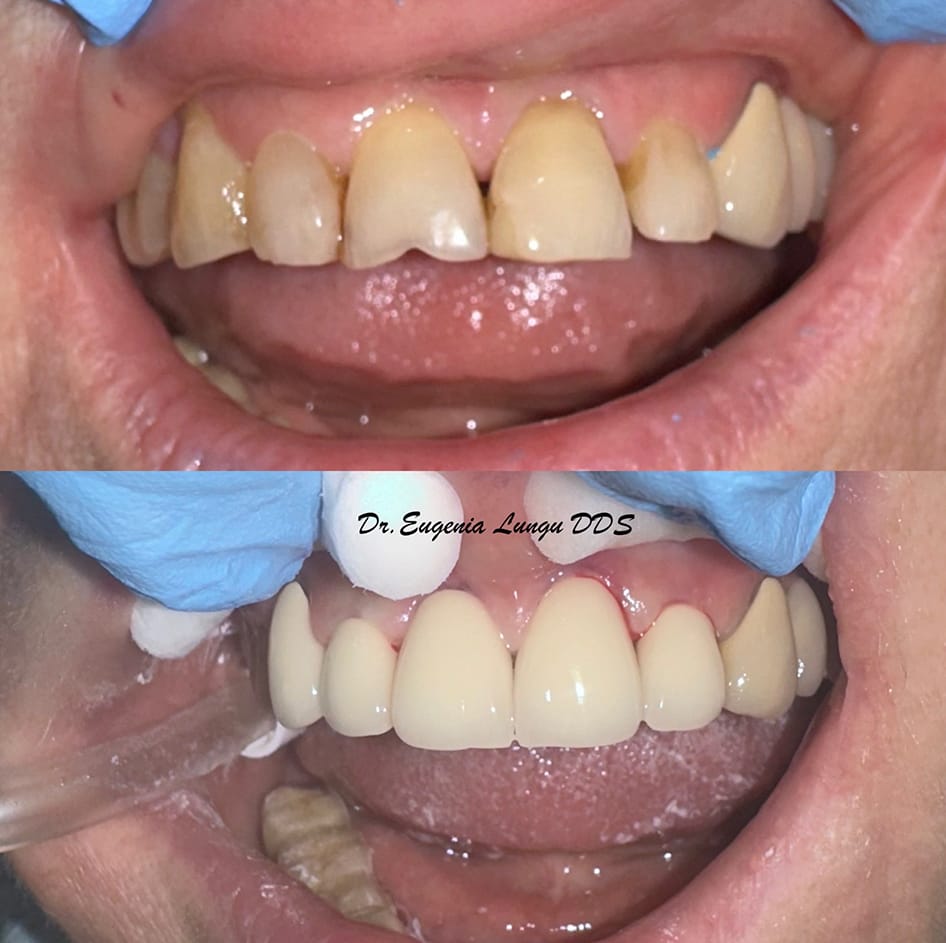 Front tooth dental veneers before and after results