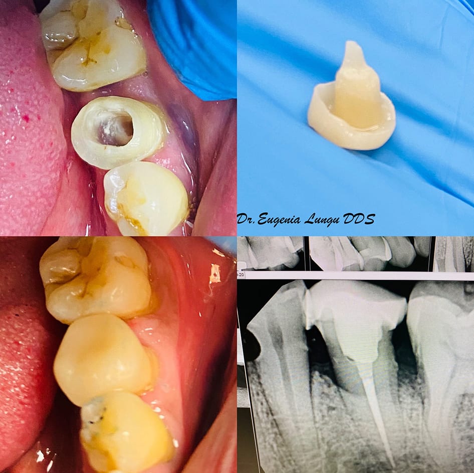 Dental crowns before and after results