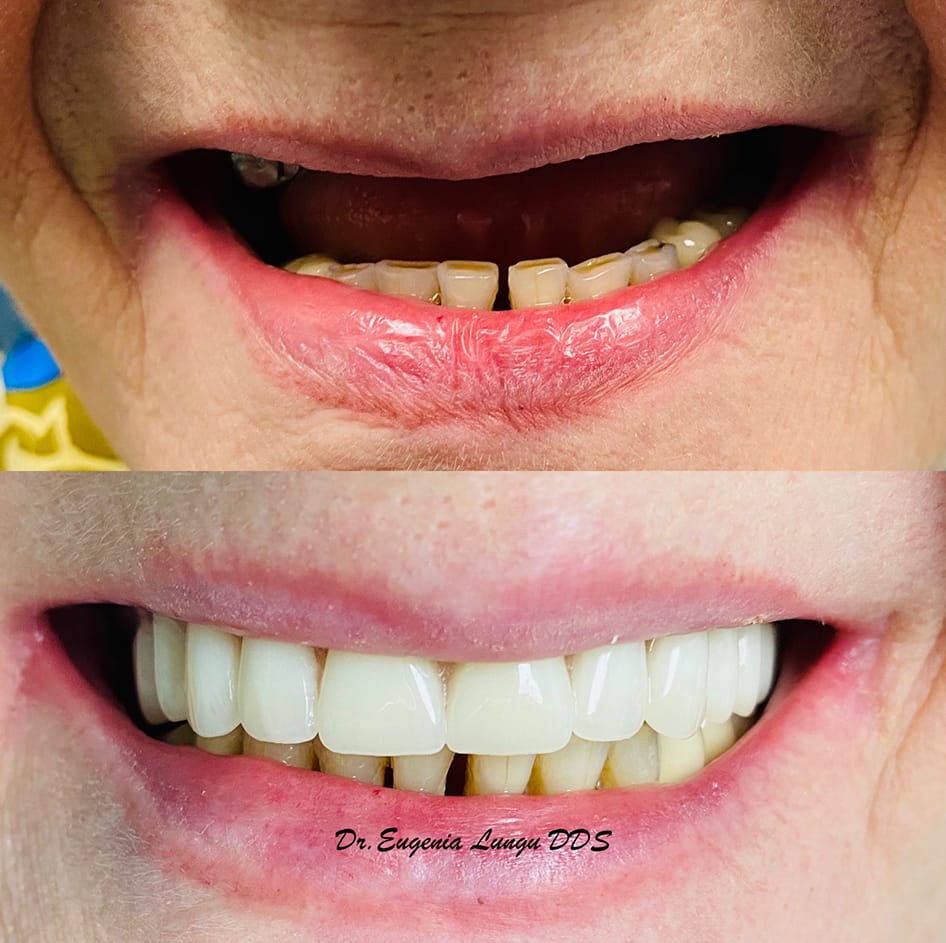 Full mouth dental veneers before and after results