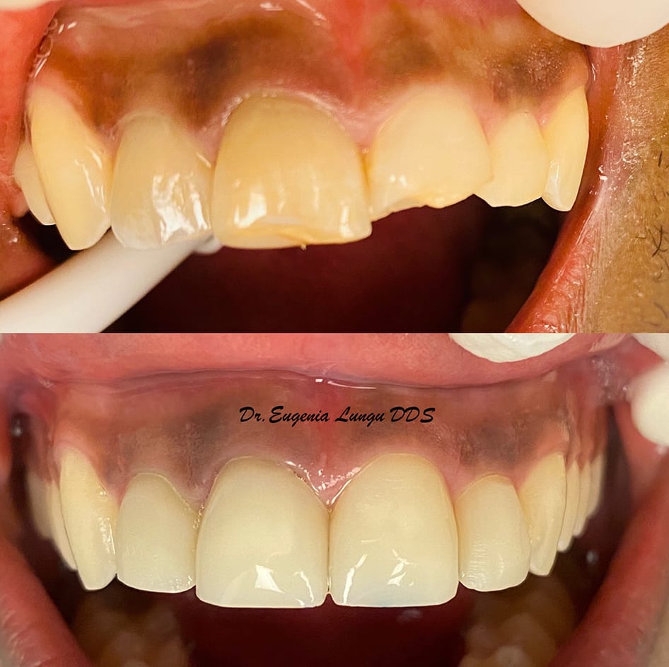 Front tooth dental crowns before and after results