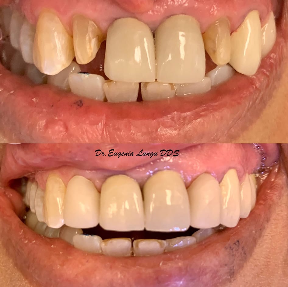 Dental crowns treatment before and after results