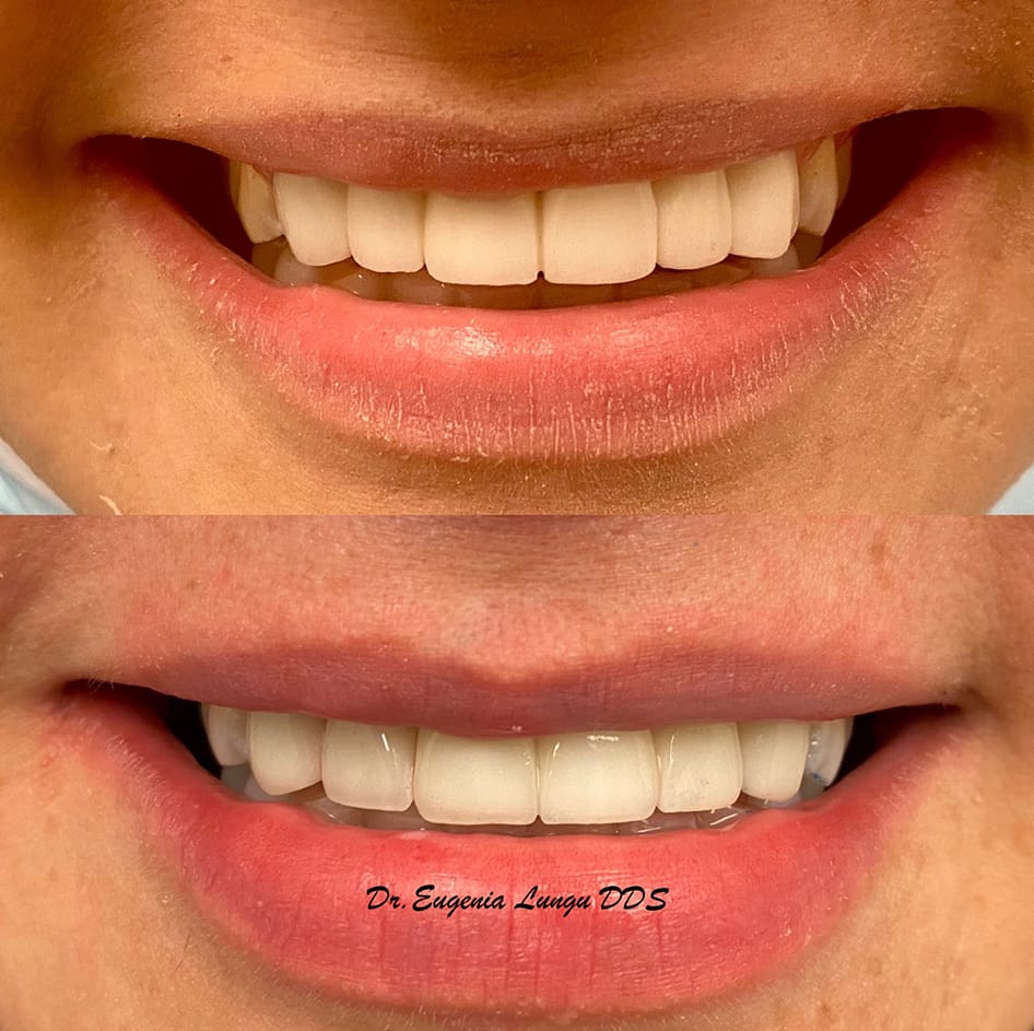 Bright smile after dental bleaching procedure