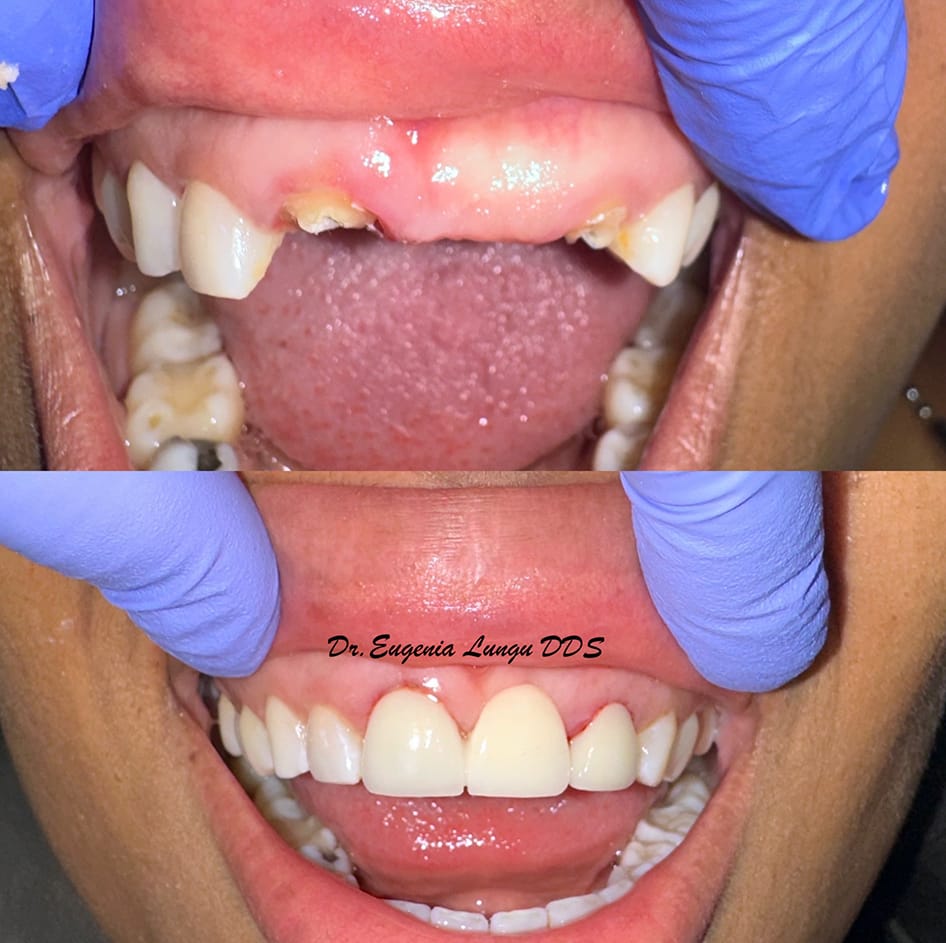 Front tooth implants before and after