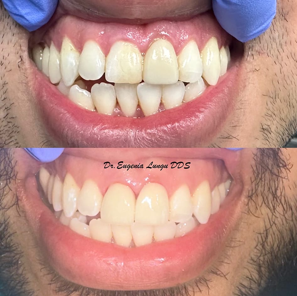 Before and after bleaching results
