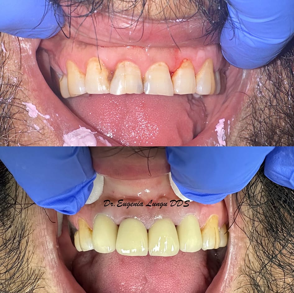 Cosmetic veneers smile makeover before and after
