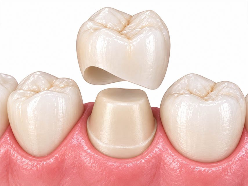 Dental Crown Preparation Process Brooklyn