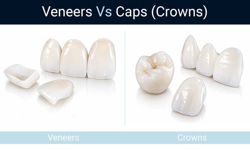 Dental veneer and dental crown comparison showing differences in tooth coverage